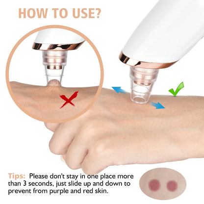 Blackhead Remover – Diepe Reiniging & Gladde Huid