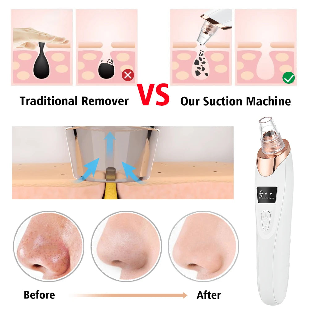 Blackhead Remover – Diepe Reiniging & Gladde Huid
