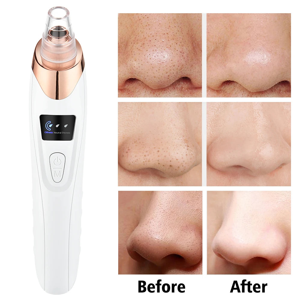 Blackhead Remover – Diepe Reiniging & Gladde Huid