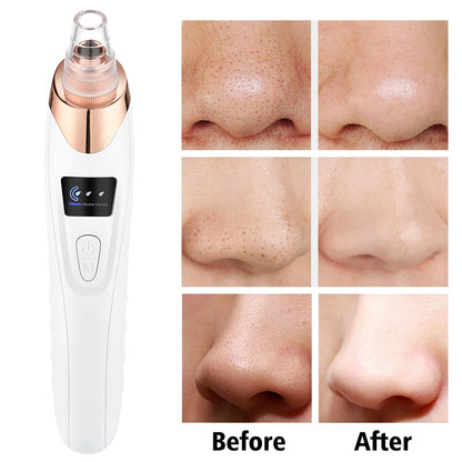 Blackhead Remover – Diepe Reiniging & Gladde Huid